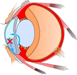 Glaucoma Eyeball